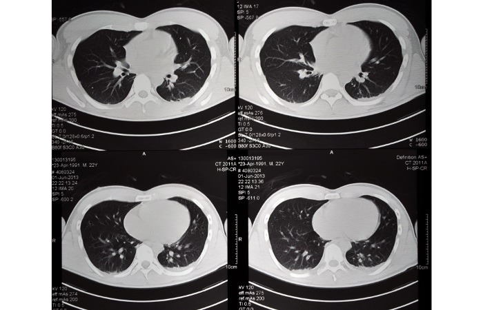 CT Scan قفسه سینه
