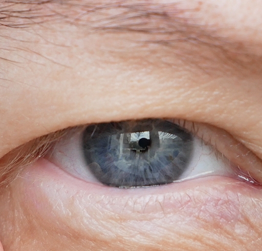 پتوزیس (Ptosis) یا افتادگی پلک چیست؟
