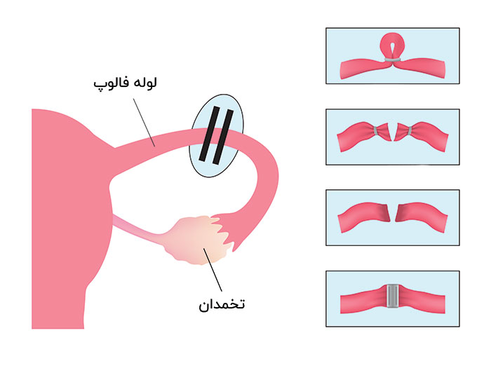 جراحی عقیم‌سازی زنان