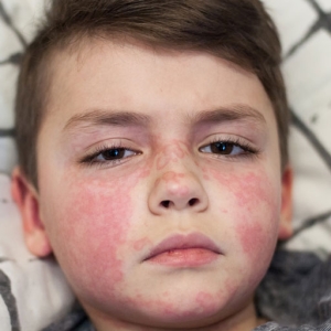 بیماری مخملک | Scarlet Fever