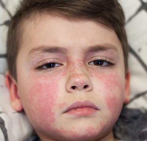 بیماری مخملک | Scarlet Fever
