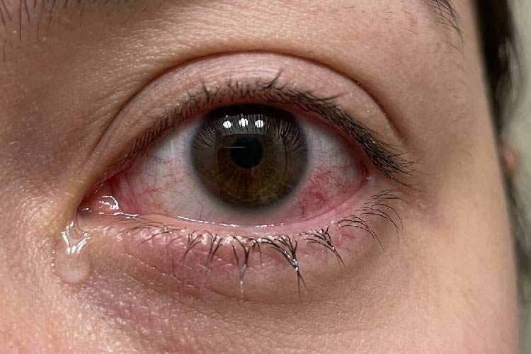 آبریزش چشم بعد از ضربه